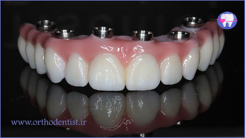 ایمپلنت کامل دندان چیست؟
