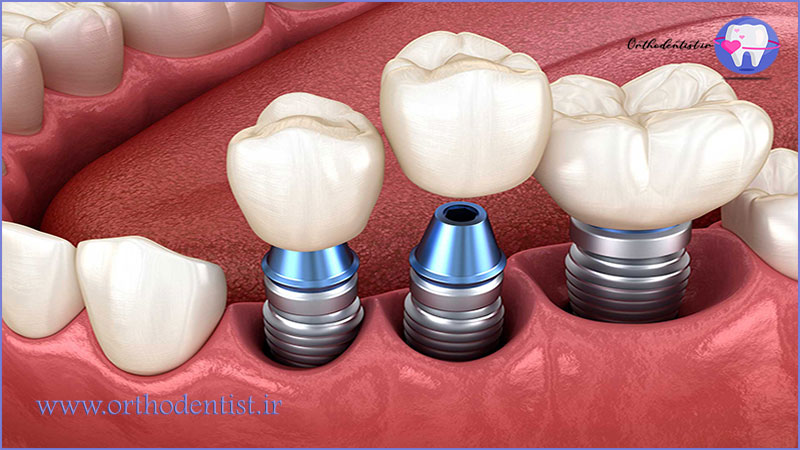 نصب تاج موقت در ایمپلنت کامل دندان