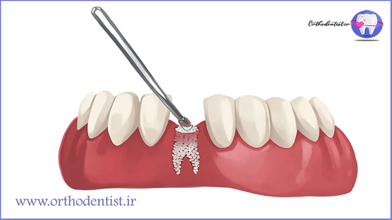 پیوند استخوان در ایمپلنت دندان
