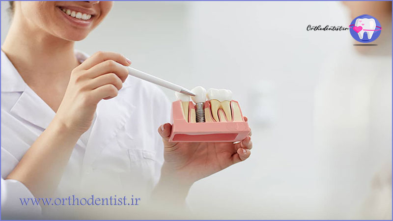 عوامل موثر بر طول عمر ایمپلنت دندان
